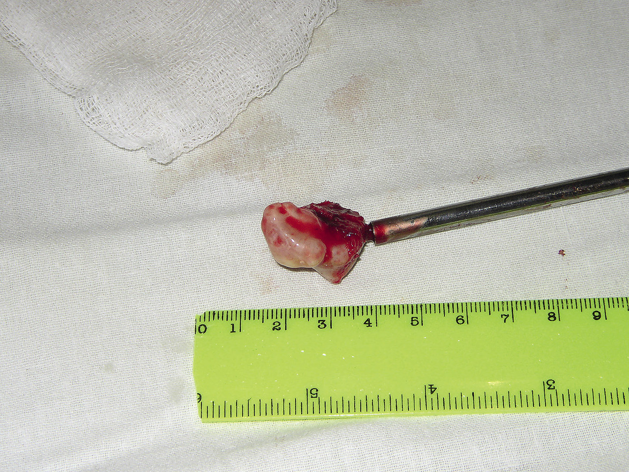 Рис. 6. Макропрепарат остеомы мыщелкового отростка нижней челюсти.