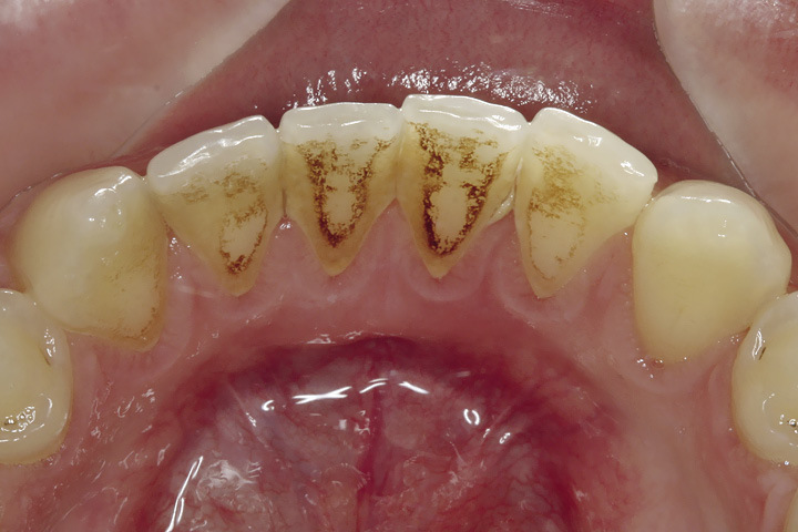 Рис. 1. Типичная локализация зубных отложений в области язычной поверхности нижних фронтальных зубов.