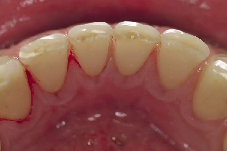 Рис. 6. Зубы пациента после завершения очистки и полировки с помощью Pro-Cup® и пасты Cleanic®.