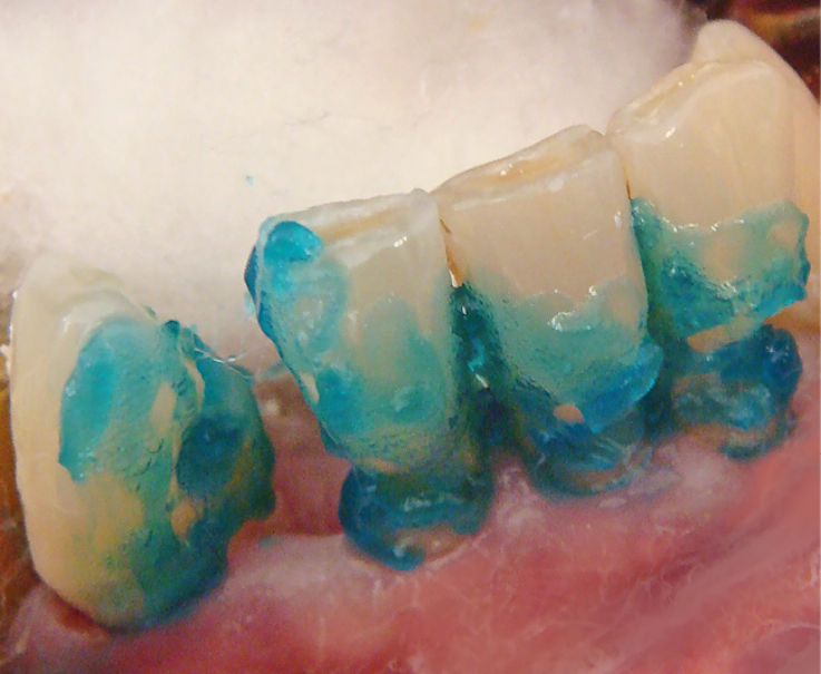 Рис. 3. Кислотное травление твердых тканей зубов.