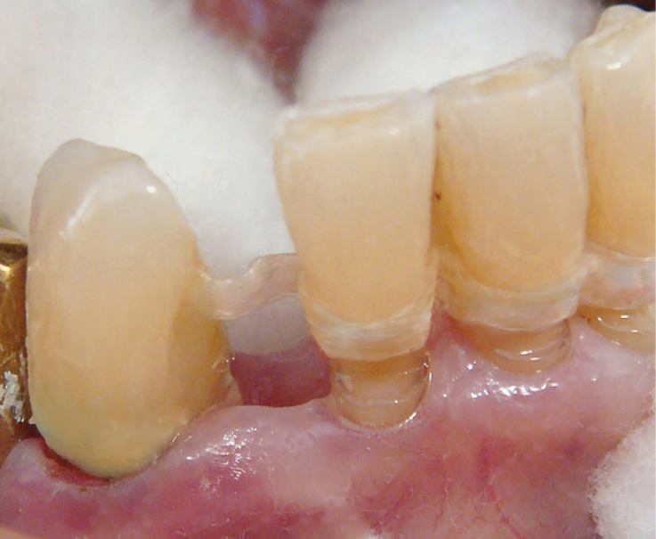 Рис. 5. Стекловолоконная лента адаптирована к зубам, создан каркас для адгезивного протеза.