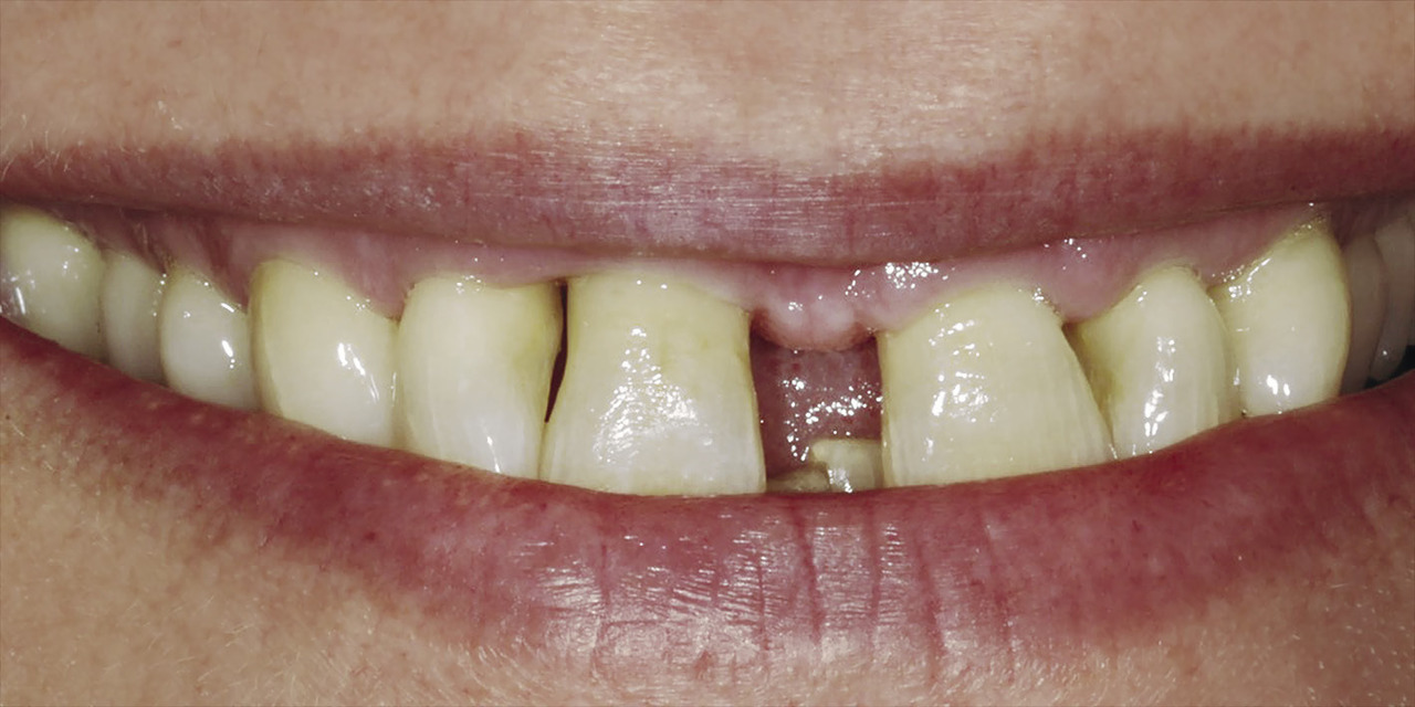 Рис. 1а. Рецессия, обнаруженная на вестибулярной стороне зубов 11 и 12.
