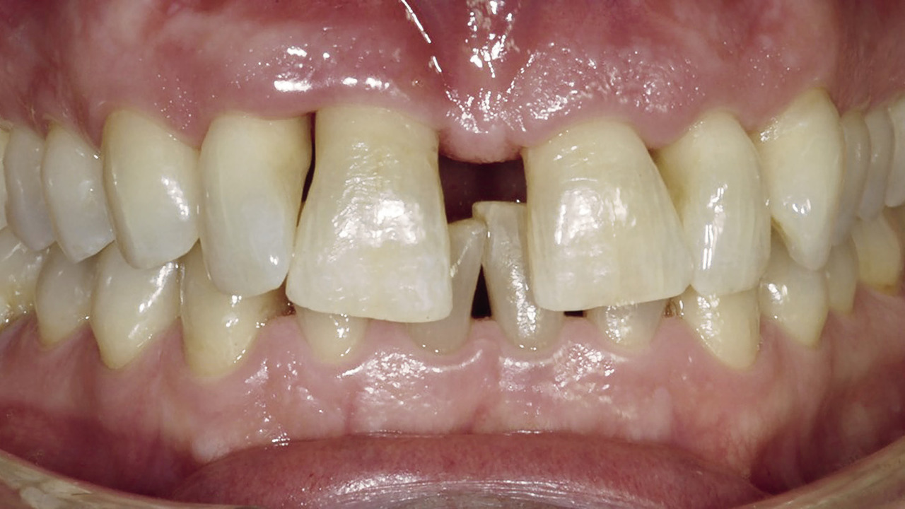 Рис. 1б. Рецессия, обнаруженная на вестибулярной стороне зубов 11 и 12.