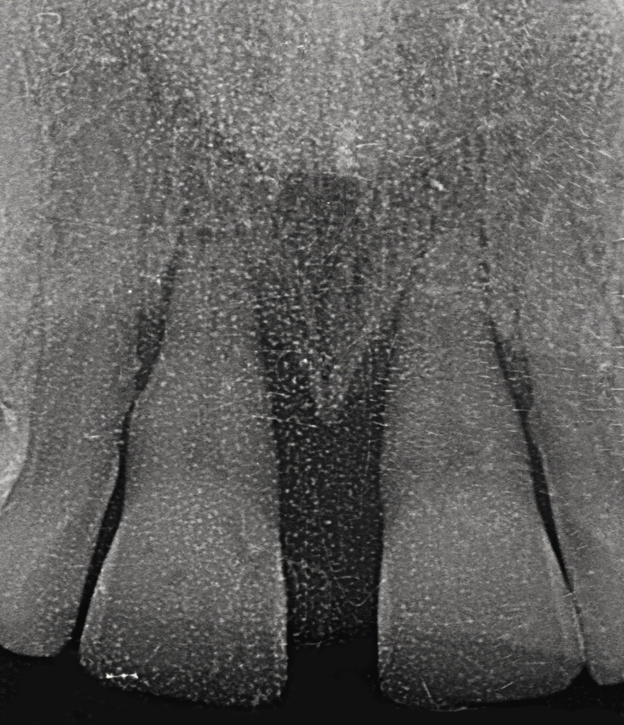 Рис. 2. Вертикальный дефект и подвижность класса III зубов 11 и 21.