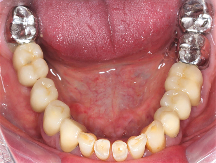 Рис. 3. Окклюзионное фото нижней челюсти пациента на первом консультативном визите.