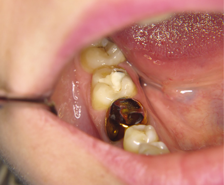 Рис. 1. Исходная клиническая ситуация: зуб 4.7 — имеется кариозная полость с остатками старой пломбы.