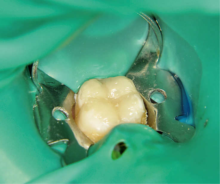 Рис. 6. Восстановление окклюзионной поверхности зуба с помощью композита «X-tra fil».