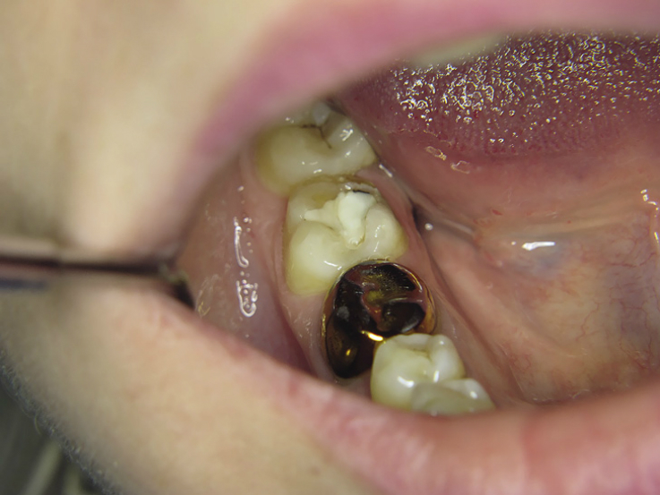 Рис. 1. Исходная клиническая ситуация: зуб 4.7 — имеется кариозная полость с остатками старой пломбы.