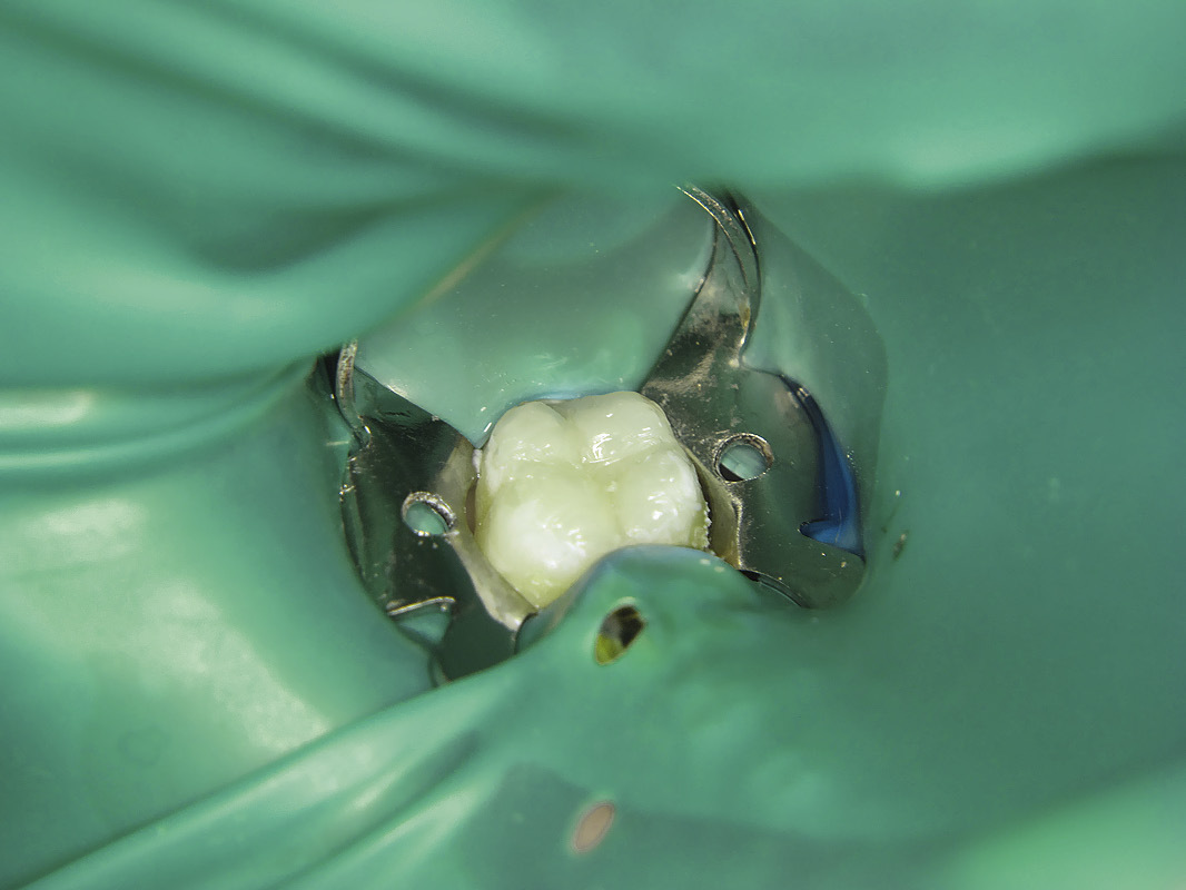 Рис. 6. Восстановление окклюзионной поверхности зуба с помощью композита «Экс-тра фил».