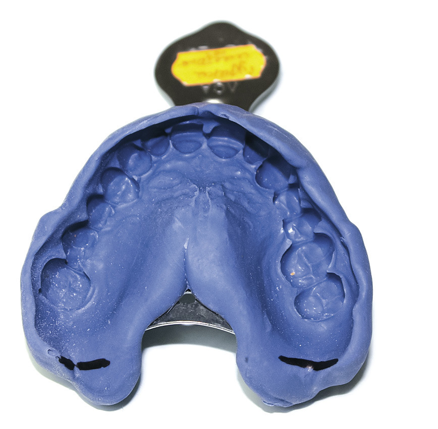 Рис. 1. Оттиск зубного ряда верхней челюсти с крылочелюстными выемками.