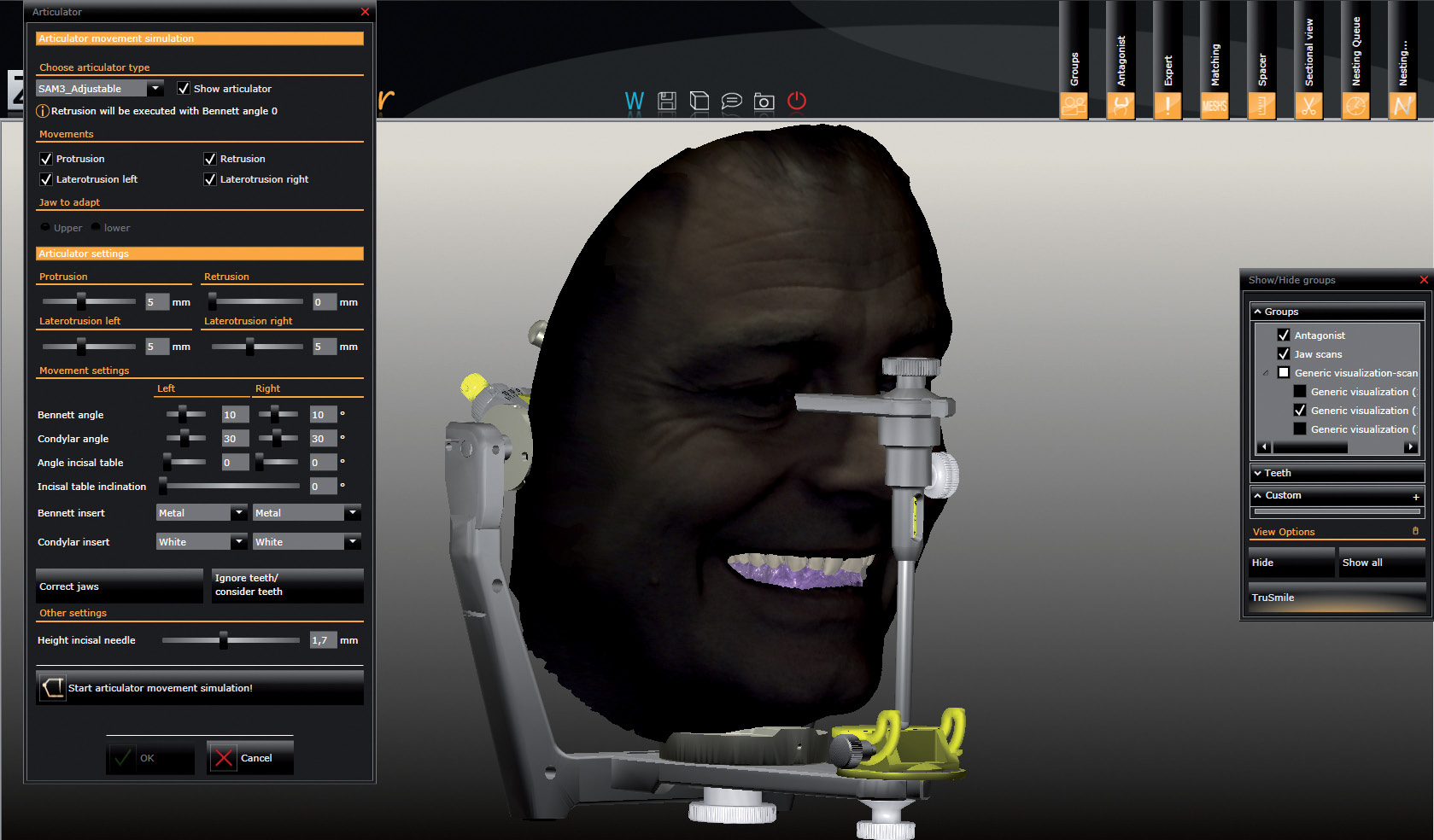 Рис. 1. Совмещение скан-данных с Face Hunter с моделью в виртуальном артикуляторе.