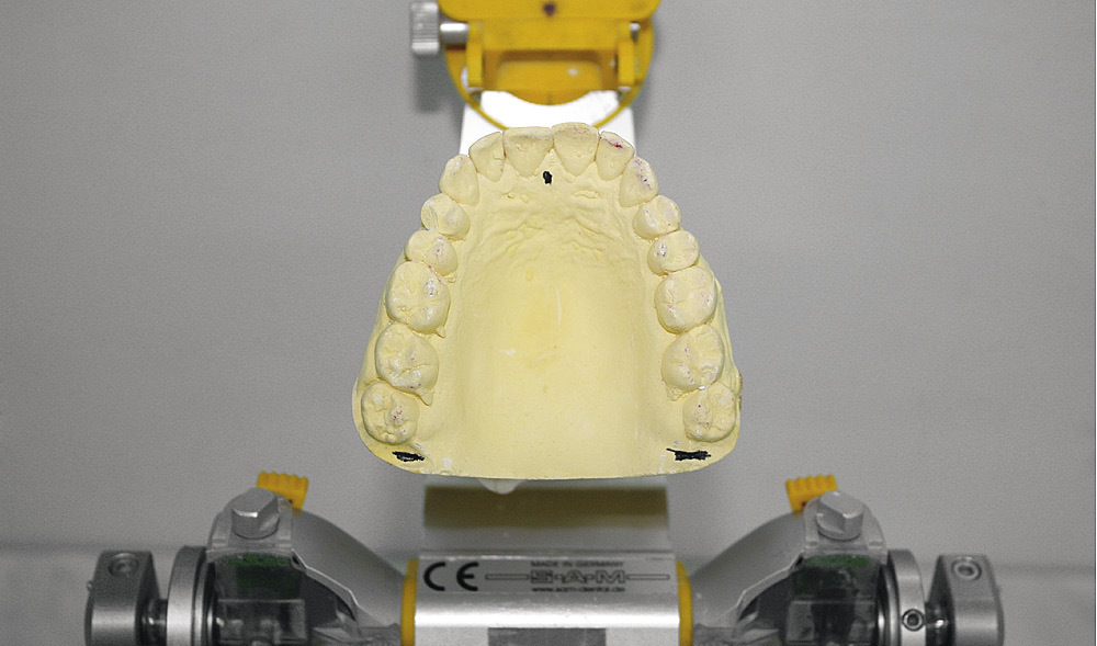 Рис. 2. Гипсовая модель челюсти.