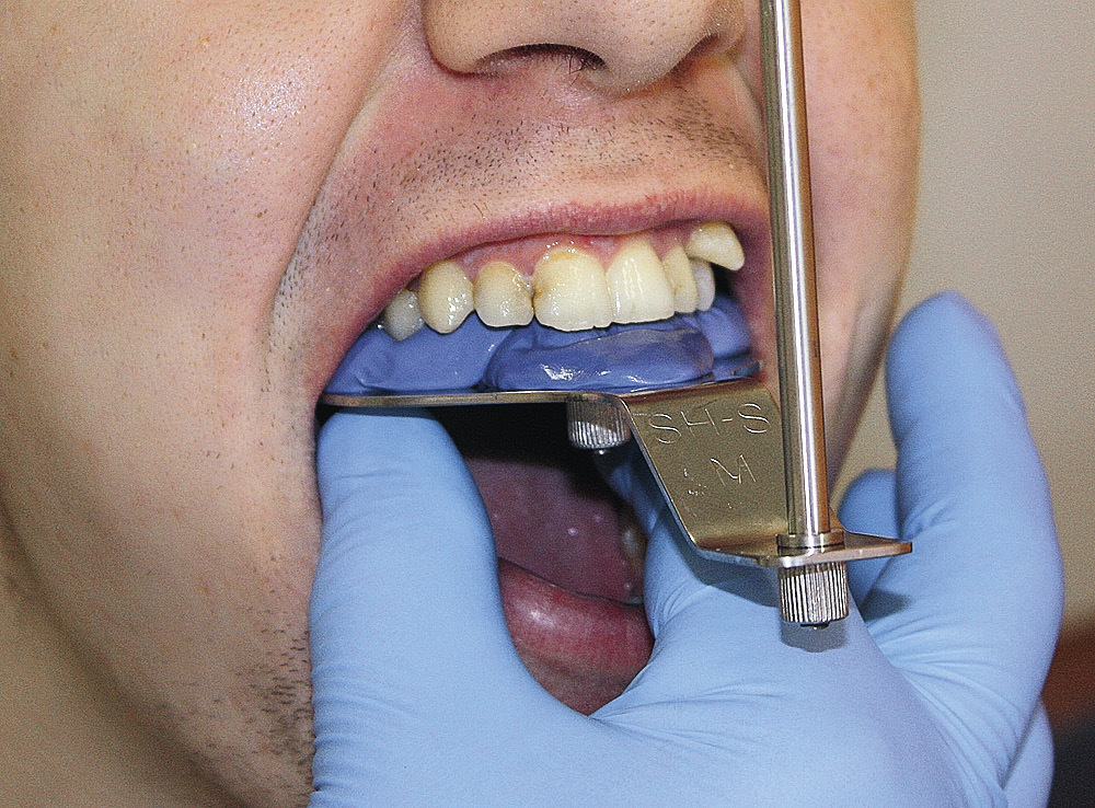 Рис. 8. Регистрация положения зубного ряда верхней челюсти относительно HIP-плоскости.