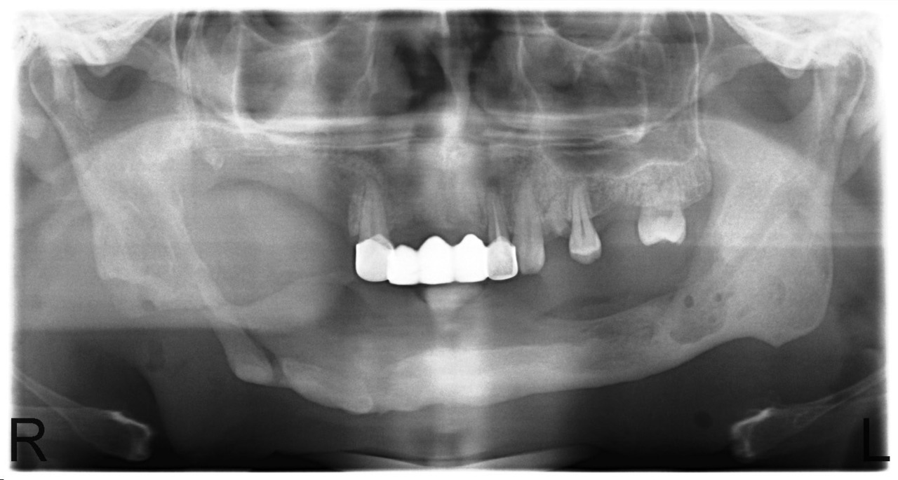 Рис. 10. Больной У. Новообразование костной ткани нижней челюсти (сентябрь 2011).