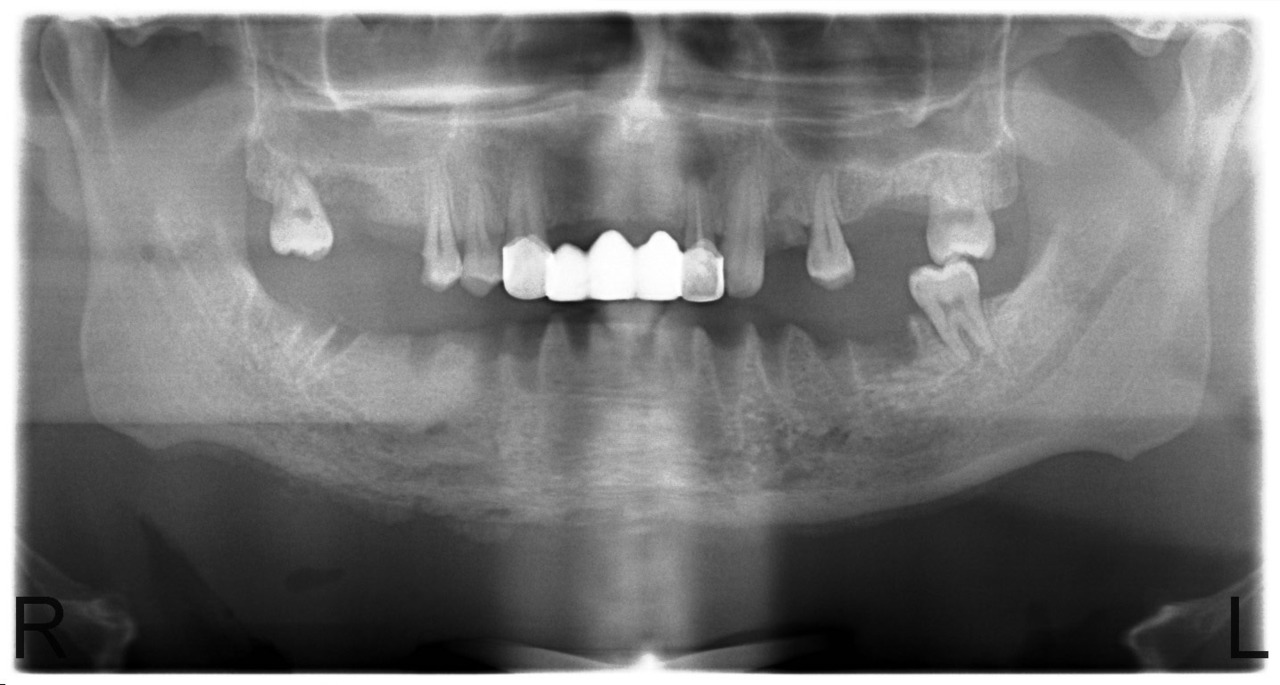 Рис. 8. Больной У., 28 лет. Диффузный остеонекроз тела нижней челюсти без зоны демаркации (апрель 2010).