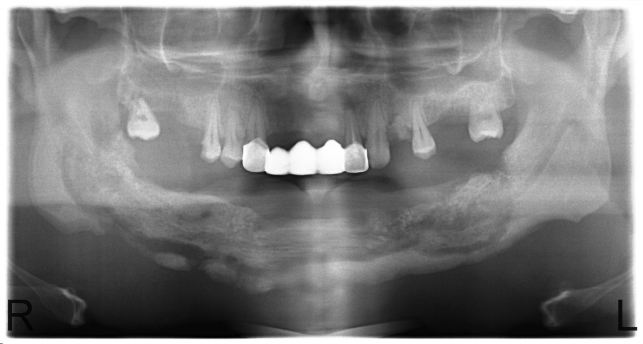 Рис. 9. Больной У. Секвестрация тела нижней челюсти с выраженной зоной демаркации и сформированным секвестром (июнь 2010).