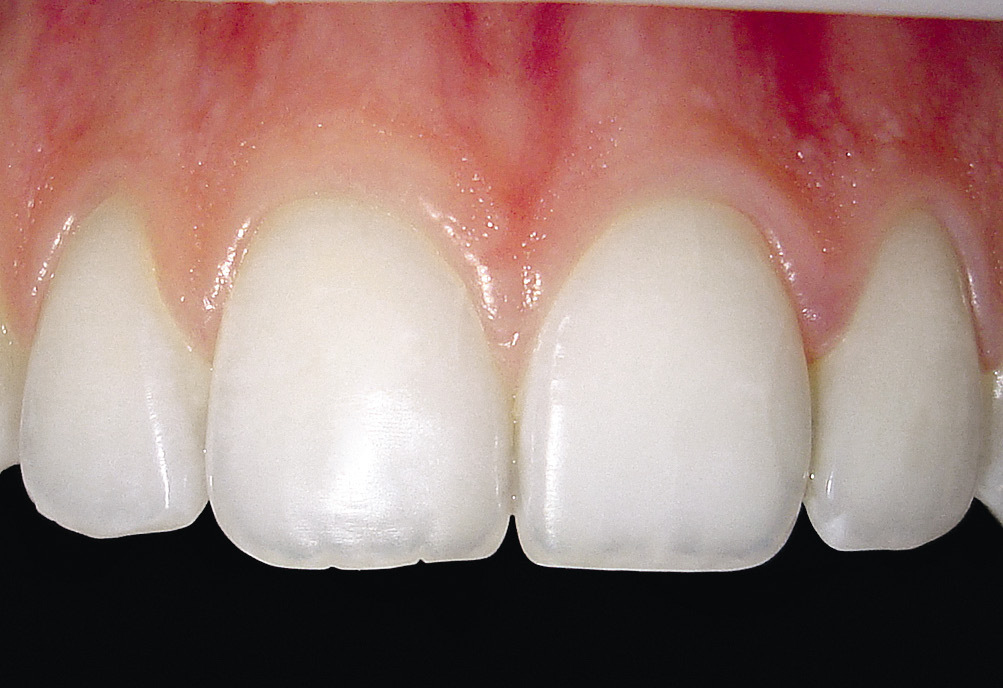 Рис. 1. Участок десны, не имеющий прикрепления к твердым тканям зуба.