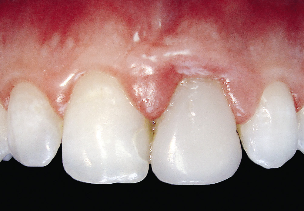 Рис. 5. Воспалительный процесс в области 21 зуба вследствие неточного края реставрации.