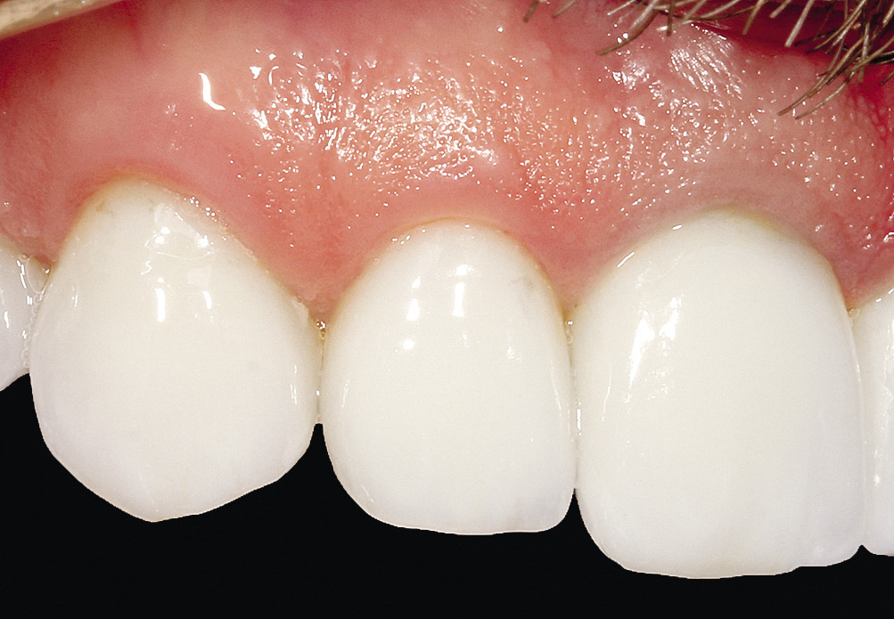 Рис. 6. Отсутствие воспаления десны в области передней группы зубов, покрытых адгезивными керамическими реставрациями.