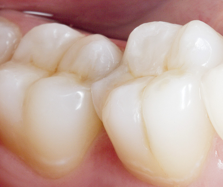 Рис. 12. Лечение кариеса с эстетико-функциональным восстановлением зубов 46, 47 завершено.