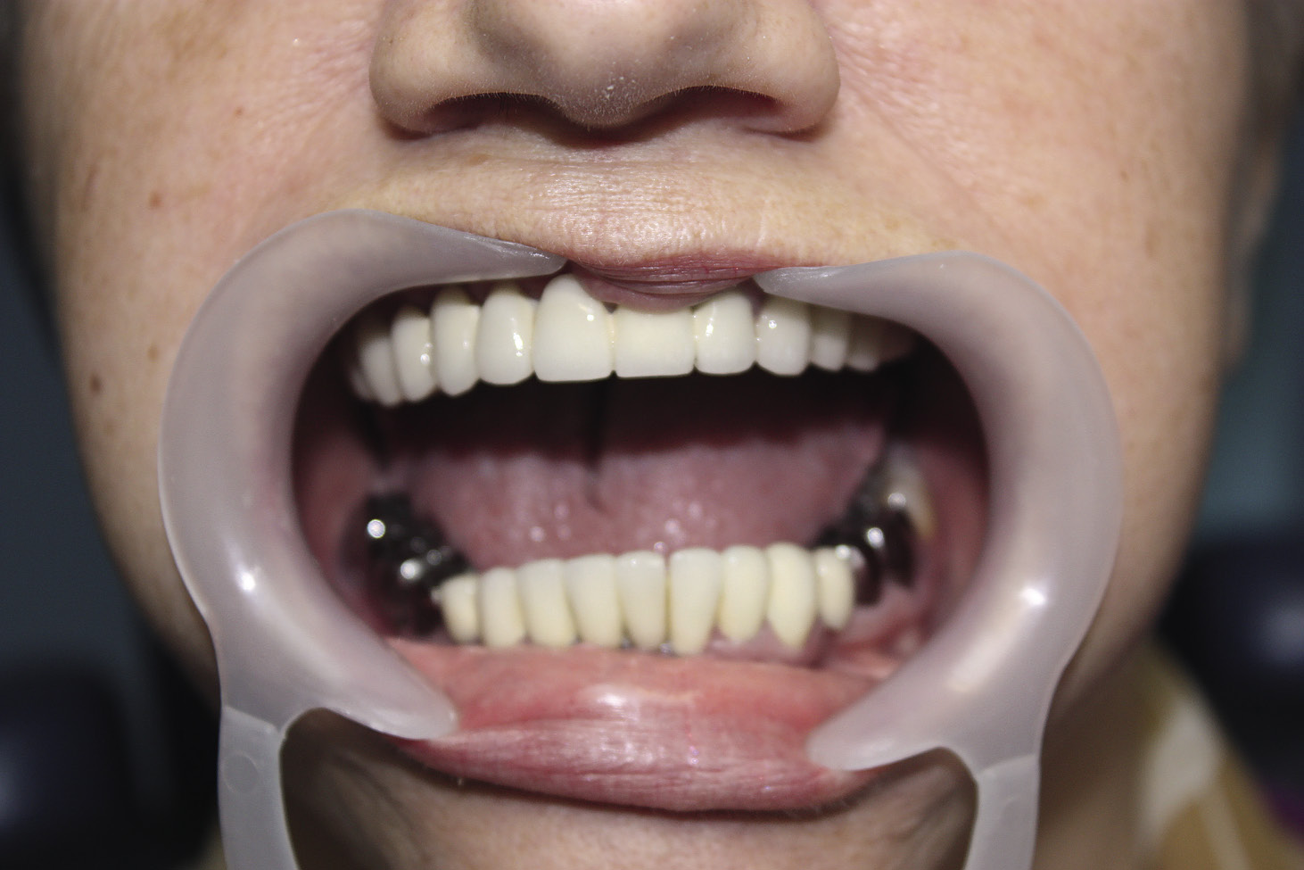 Рис. 2. Поражение зуба, затрагивающее эмалево-дентинную границу. Требуется инвазивное лечение.