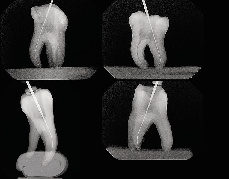 Рис. 2. Примеры зубов, вошедших в данное исследование с разными показателями кривизны каналов.