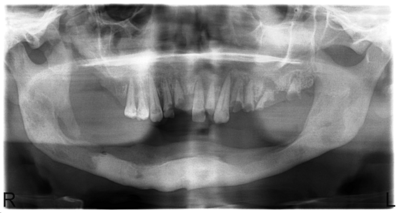 Рис. 5. Больной Ш., 31 года. Состояние спустя 8 месяцев после секвестрэктомии на нижней челюсти. Диффузный остеонекроз альвеолярного отростка верхней челюсти.