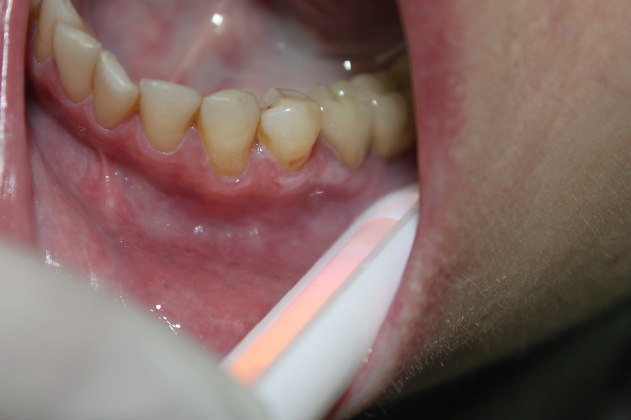 Рис. 1а. Осмотр полости рта пациентки со специальным фонариком при приглушенном внешнем освещении.