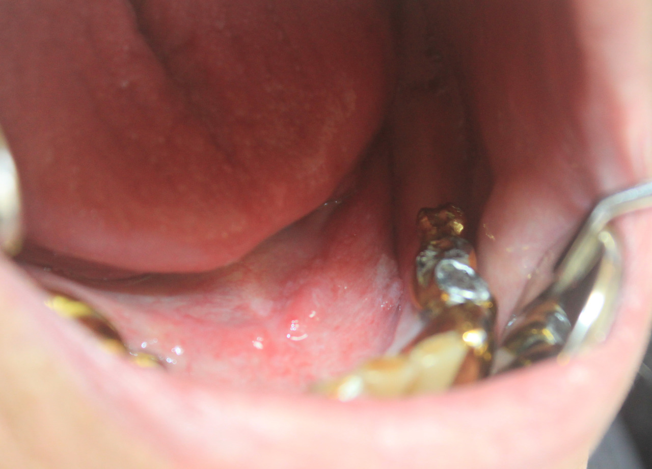 Рис. 2. Лейкоплакия слизистой оболочки рта пациента С.