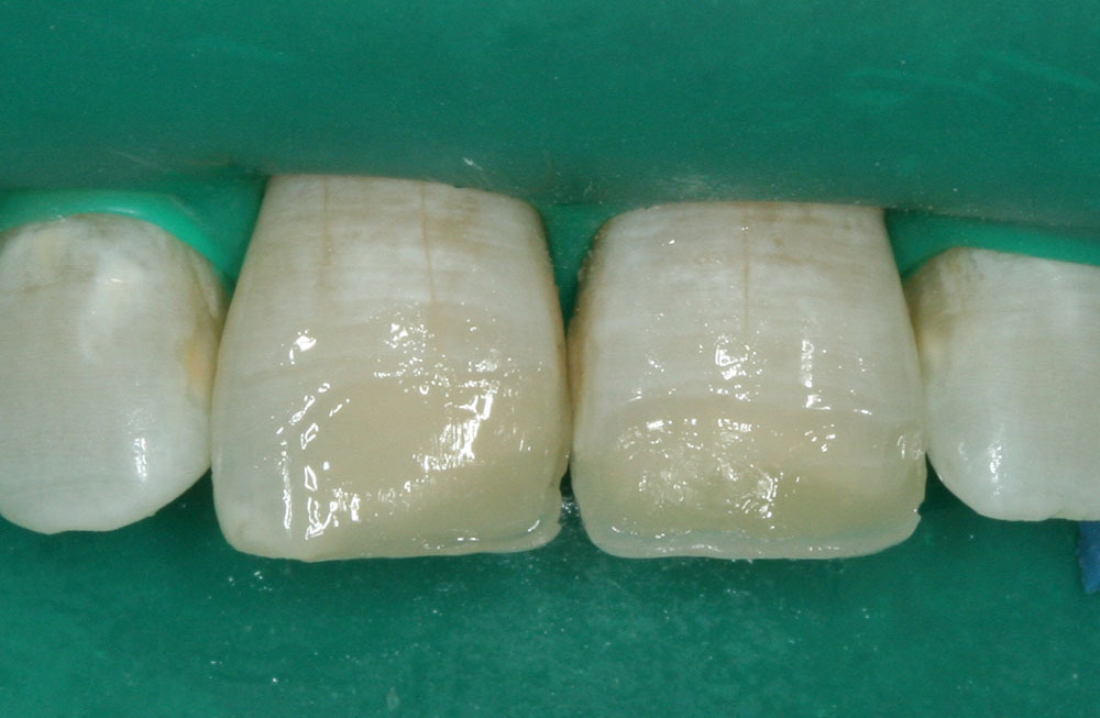 Прямая композитная реставрация передних зубов. Клинический случай 