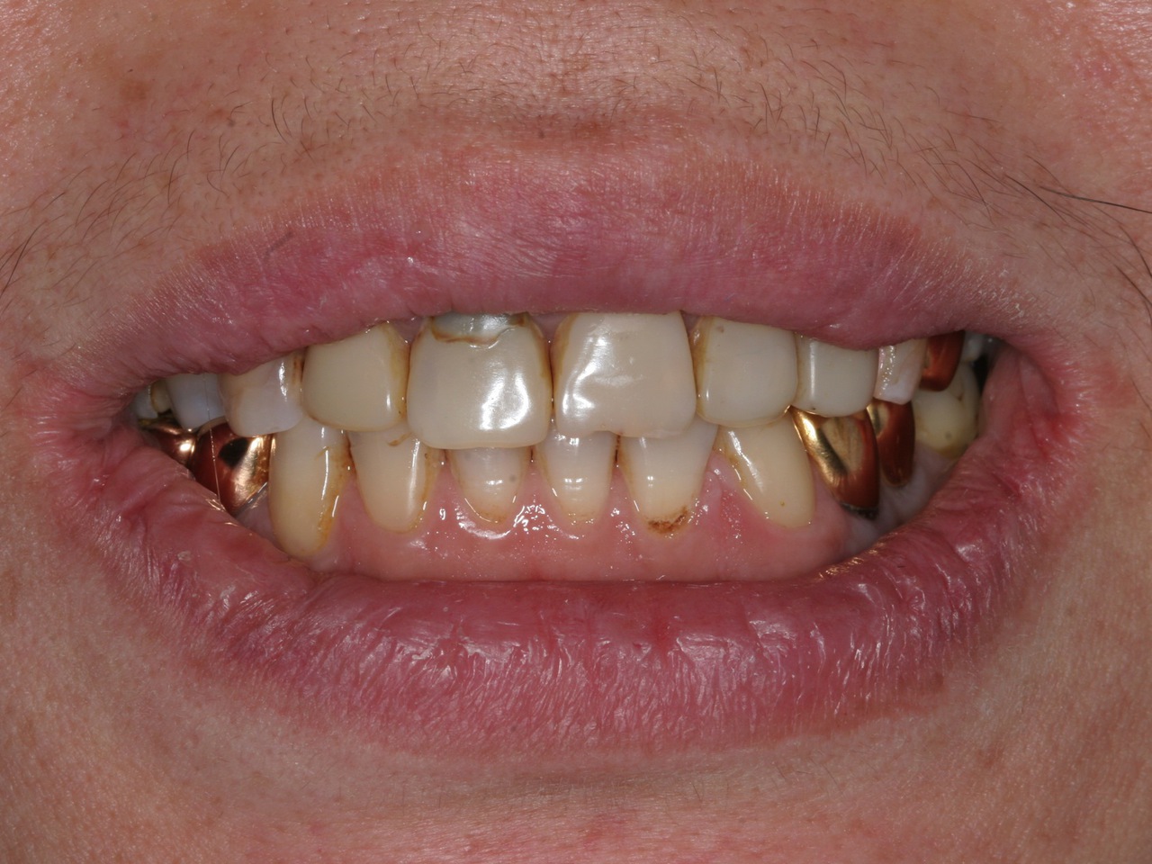 Эстетическая реабилитация зубов фронтальной группы методикой 