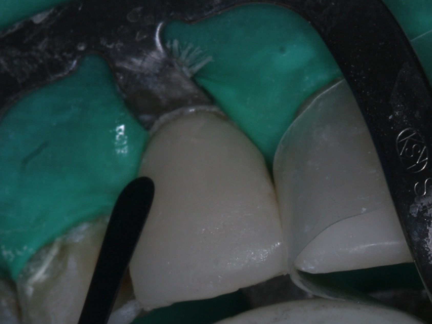 Эстетическая реабилитация зубов фронтальной группы методикой 