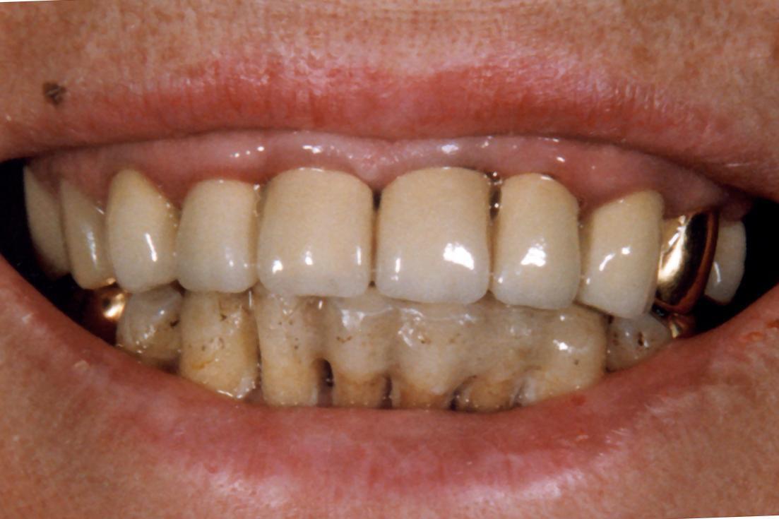 Рис. 1. Пациентка В., 1997 г. Пациентку не устраивает внешний вид фронтальной группы зубов верхней и нижней челюстей.