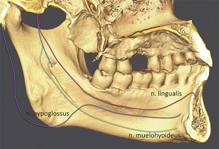 Рис. 13. Возможный путь дополнительной иннервации центральных резцов нижней челюсти язычным нервом (n. lingualis).