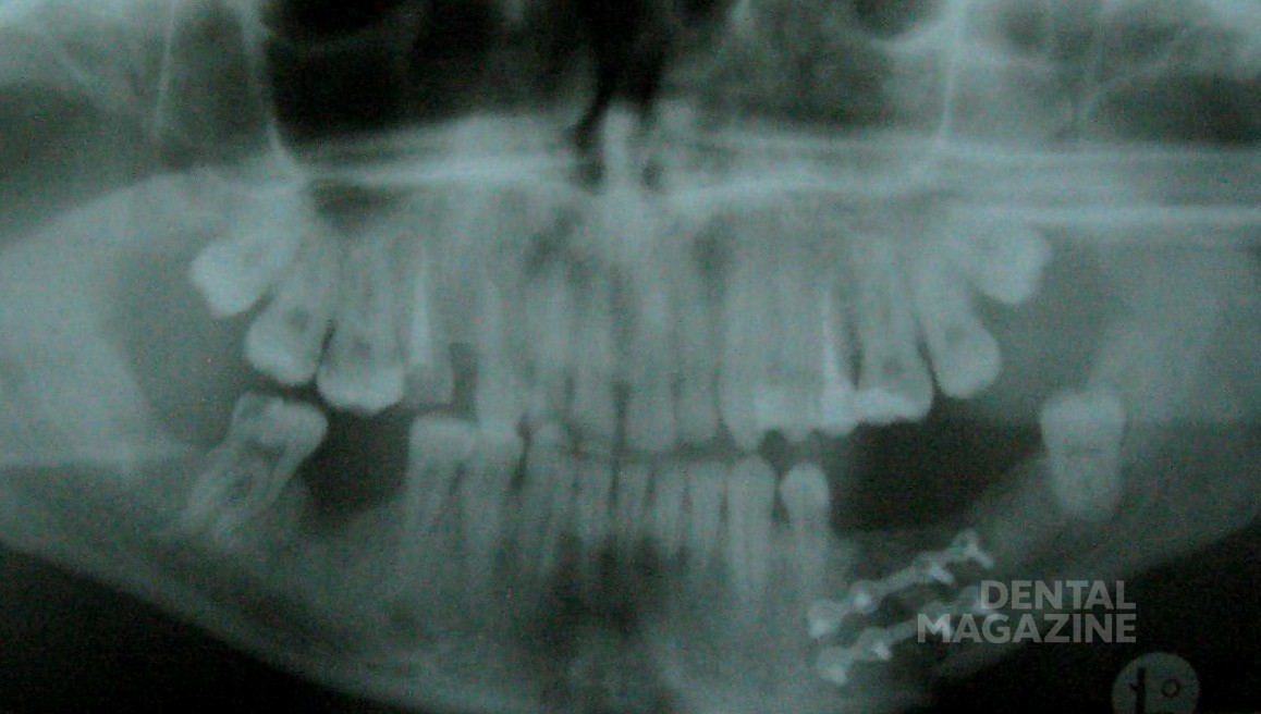 Рис. 4. Двусторонний перелом нижней челюсти. Осуществлена иммобилизация с помощью остеосинтеза и брекет-фиксаторов.