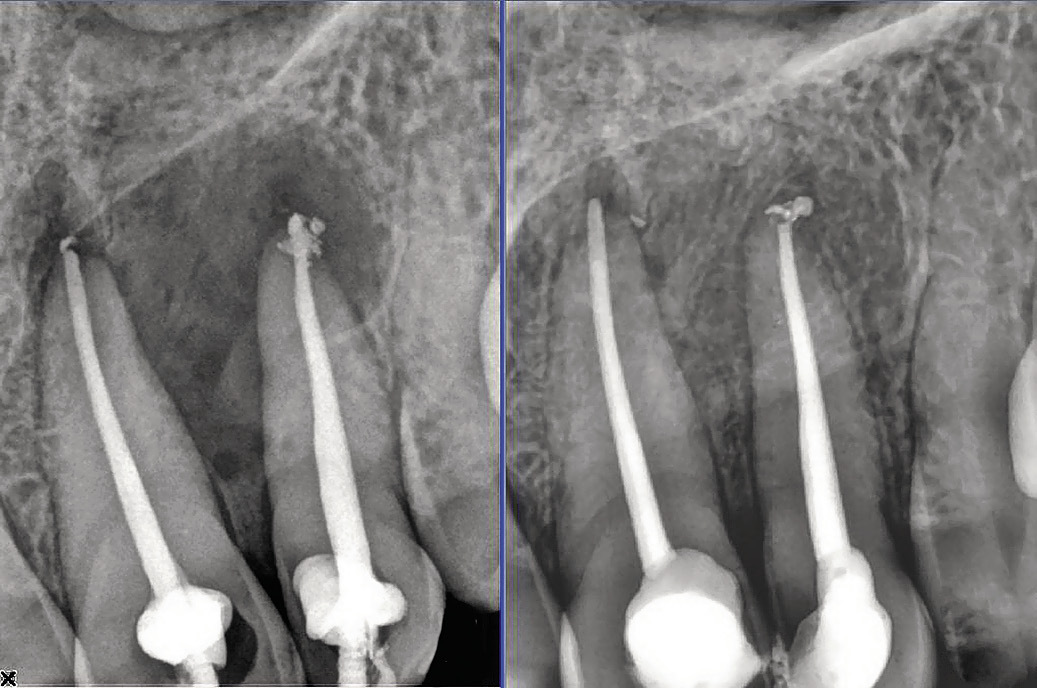Рис. 2. Контрольный снимок непосредственно после лечения зубов 21, 22 (хронический периапикальный абсцесс в состоянии нагноения) (а) и отсроченный контрольный снимок через 5 месяцев после пломбирования канала (б), состояние репарации на этапе лечения.