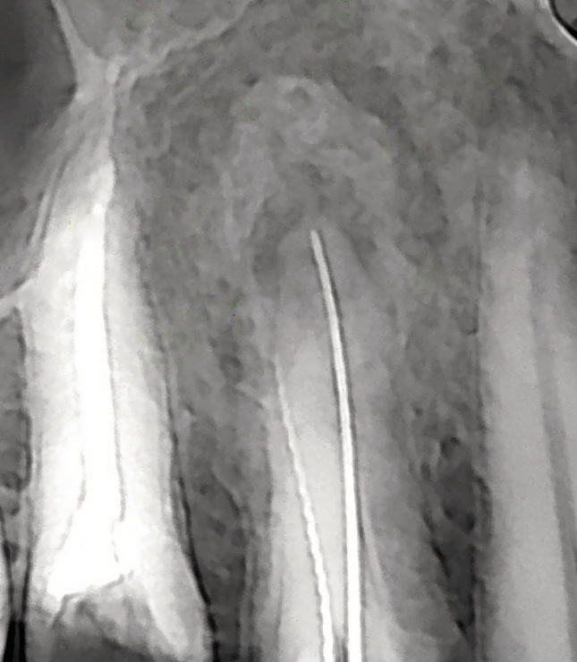 Рис. 3. Внутриротовой снимок зуба 24, хронический периапикальный абсцесс (К04.6), визуально определяется зона деструкции костной ткани с характерным перифокальным склерозом.