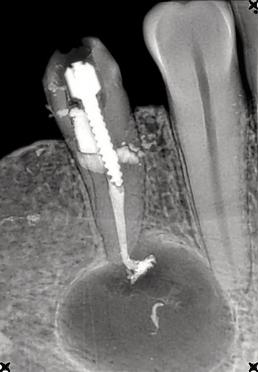 Рис. 4. Внутриротовой снимок зуба 44, радикулярная киста (К04.7), воспалительная ремоделяция перифокальной костной ткани отсутствует (пояснение в тексте).