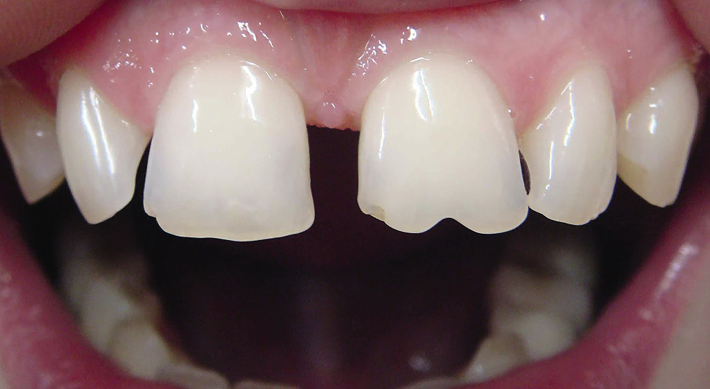 Рис. 2. Широкий промежуток между центральными и латеральными резцами, стертость режущего края 11 и 21 зубов.