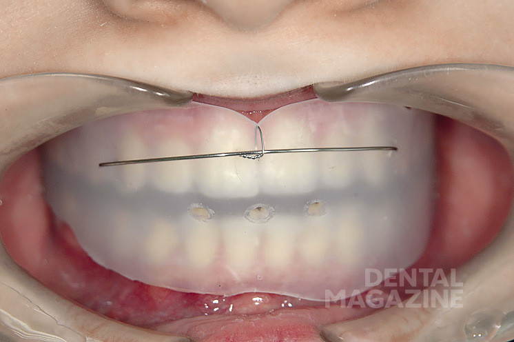 Рис. 2г. Использование механически действующих элементов в корректорах: введена вестибулярная проволочная дуга для усиления работы над торком фронтальной группы зубов.