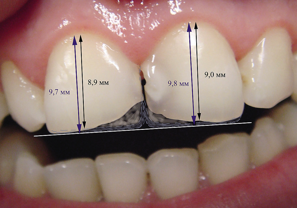 Рис. 3. Планирование размеров, формы и типа прозрачности зубов.