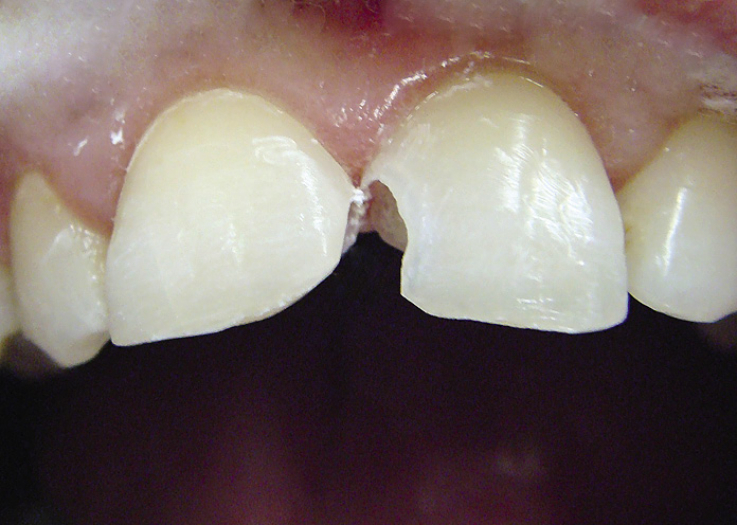 Рис. 5. Зубы после некрэктомии.