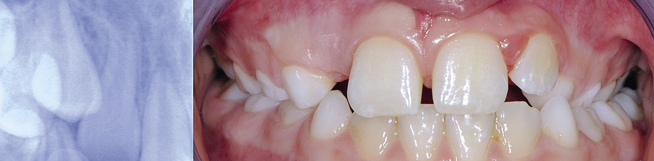 Рис. 9 а) На рентгенограмме, сделанной через 12 мес., отмечается значительно более низкое (каудальное) положение 12 зуба и прогрессирующий рост корня. б) Клинически 12 зуб еще не прорезался. 63, 64, 65 и 26 зубы находятся в перекрестном прикусе.