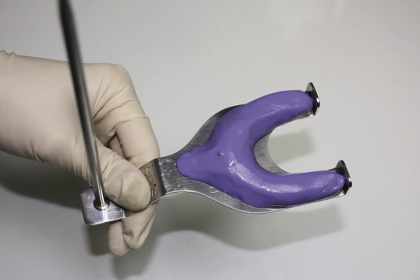 Рис. 4. Оттискной силиконовый материал, нанесенный на анализатор для получения оттиска зубного ряда верхней челюсти.
