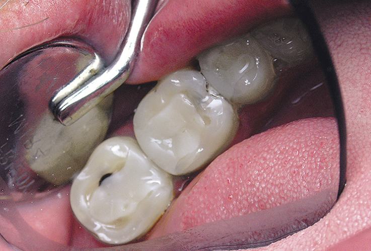 Рис 1. Исходная клиническая ситуация: зубы 2.5, 2.6 и 2.7 — имеются скрытые кариозные полости на контактных поверхностях.