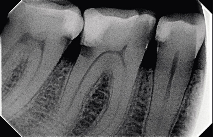 Рис. 2. Рентгенограмма зубов.