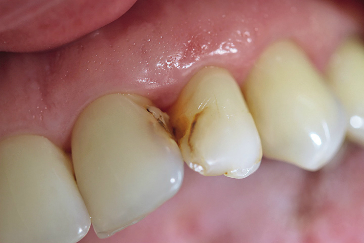 Рис. 2. Несостоятельные реставрации на контактных поверхностях зубов 21 и 22.