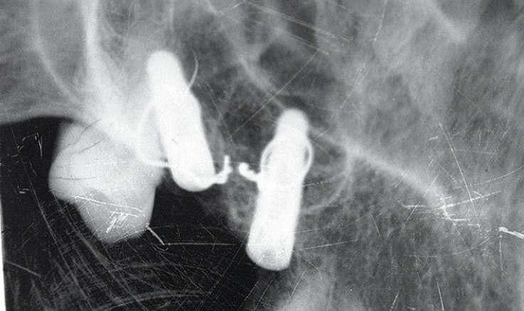 Рис. 5. Контрольный рентгенологический снимок.