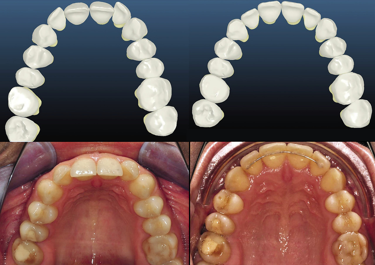 Рис. 7. Аксиальные реформаты КЛКТ на расстоянии 3 и 6 мм от цементно-эмалевого соединения центрального резца демонстрируют наличие кости вестибулярно от зубов (В/Ч).