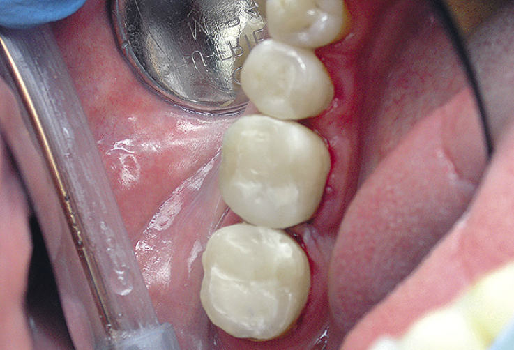 Рис. 8. Вид зубов 2.5, 2.6 и 2.7 после реставрации.